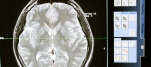 MRI scan of the brain