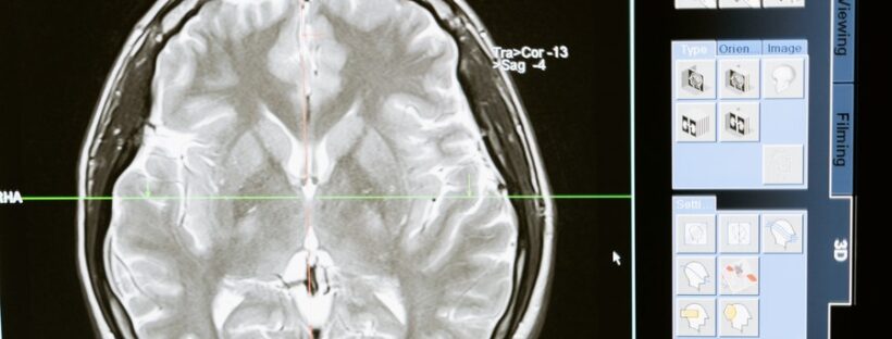 MRI scan of the brain